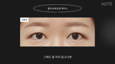 논현 쌍꺼풀수술 눈성형 유명한 곳 추천 강남 노트성형외과의 절개 눈매교정이란? 관련 이미지 6