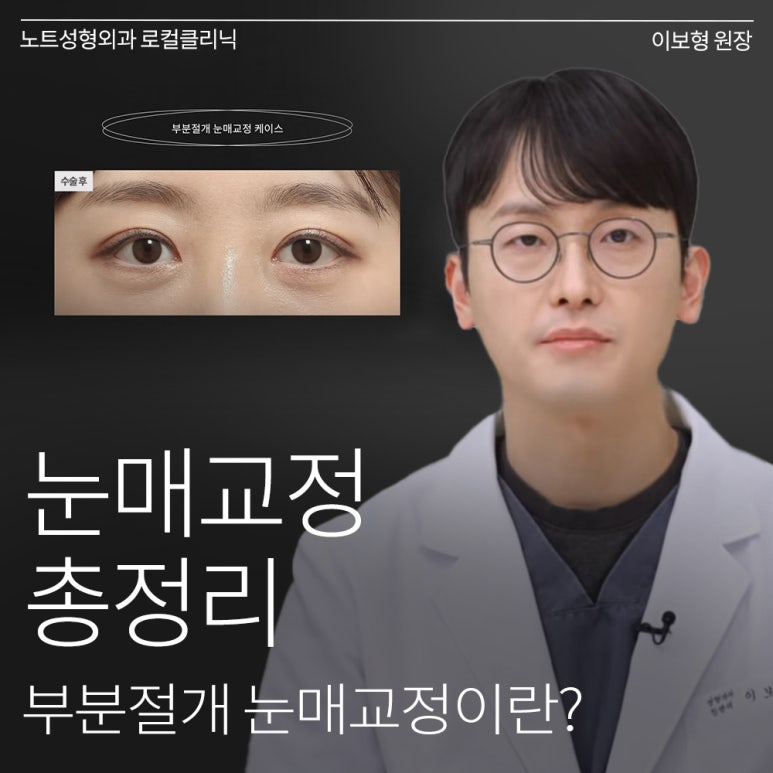 Recommended Place for Double Eyelid Surgery in Gangnam: What Is Partial-Incision Ptosis Correction at Nonhyeon NOTE Plastic Surgery? image 1