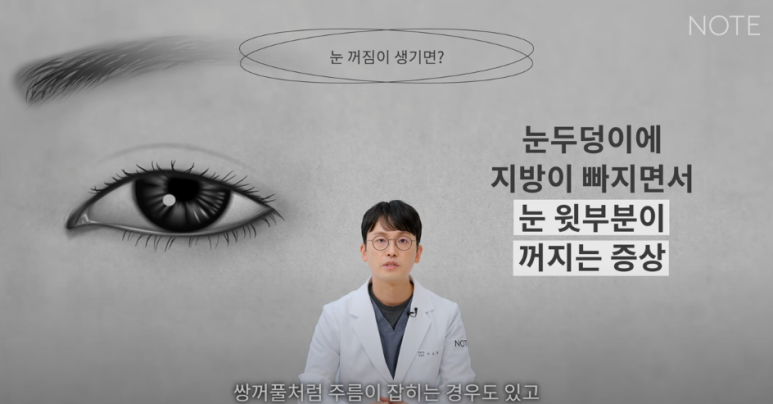꺼진 눈이 생기는 이유는 따로 있다? 강남 눈성형 잘하는 곳 추천 노트성형외과의 눈꺼짐 해결을 위한 쌍커풀성형과 눈매교정, 지방이식수술 관련 이미지 7