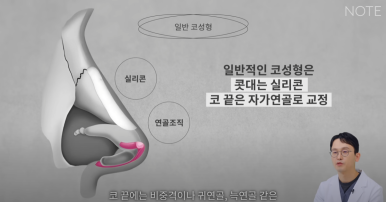 강남 코성형외과 코수술 잘하는 곳 추천 논현역 노트성형외과의 무보형물 자가연골 코성형수술로 자연스러운 코성형 관련 이미지 5