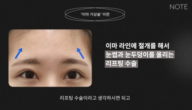 강남 성형외과 유명한 곳 논현역 리프팅 잘하는 곳 노트성형외과의 이마거상수술 쌍꺼풀수술 관련 이미지 6
