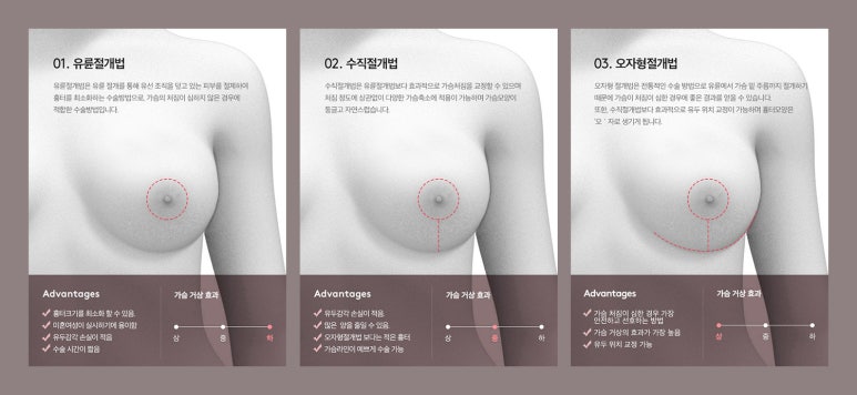 [NOTE Plastic Surgery] Sagging Breasts After Childbirth: What Are the Improvement Methods? image 3