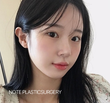 What Eyelid Surgery Suits Me Best? Get Double Eyelids and Epicanthoplasty at Once! A Famous All-in-One Eyelid Surgery Clinic in Gangnam, Note Plastic Surgery image 3