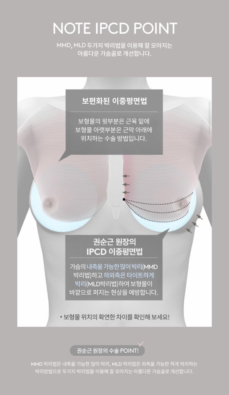 가슴성형 모티바 보형물, 노트성형외과에서 전합니다. 관련 이미지 3