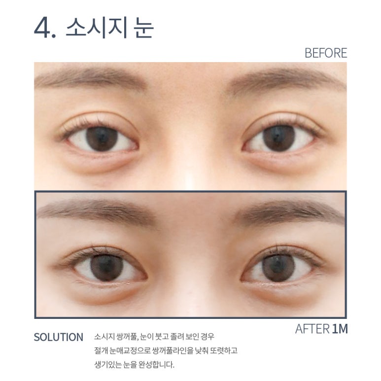 강남 쌍꺼풀재수술 잘하는 곳 논현역 노트성형외과의 소시지 쌍수 눈재수술 후기 관련 이미지 10