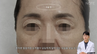 논현 안면거상 성형외과 리프팅 유명한 곳 강남 노트성형외과의 안면거상 케이스 리뷰 수술 전 고민 관련 이미지 5