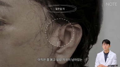 논현 리프팅 안면거상술 유명한 곳 추천 강남 노트성형외과의 안면거상 케이스 리뷰 수술 후 한 달 차 관련 이미지 4