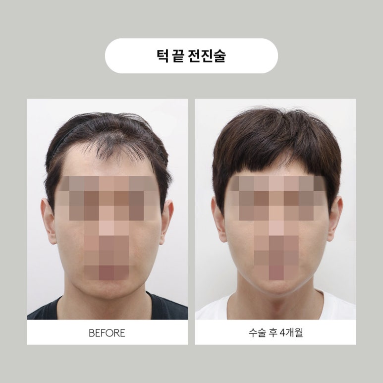Contours for Men, Note Plastic Surgery Men’s Contouring image 7