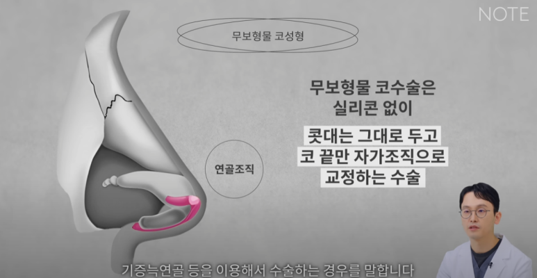 강남 코성형외과 코수술 잘하는 곳 추천 논현역 노트성형외과의 무보형물 자가연골 코성형수술로 자연스러운 코성형 관련 이미지 11