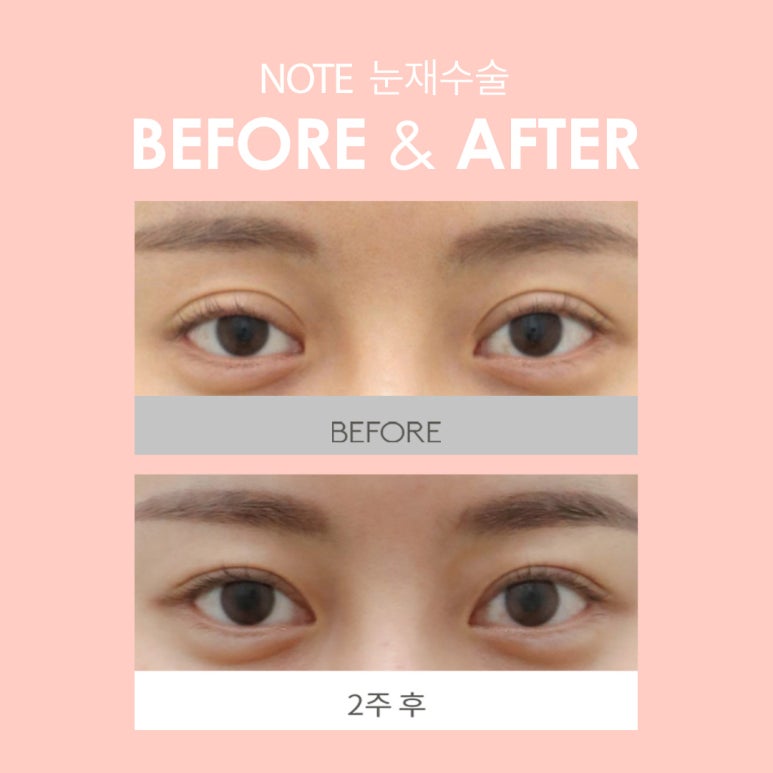 소세지 눈재수술, 눈재수술 붓기 걱정 없는 논현역 눈재수술 성형외과 노트의 당신에게만 집중하는 눈재수술 관련 이미지 8