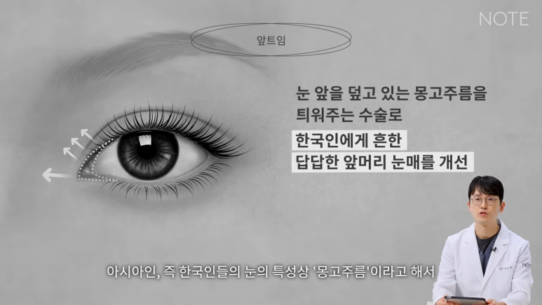 강남 트임수술 쌍꺼풀 눈성형 잘하는 곳 추천 논현 노트성형외과의 트임을 하는 이유, 앞트임이란? 관련 이미지 3