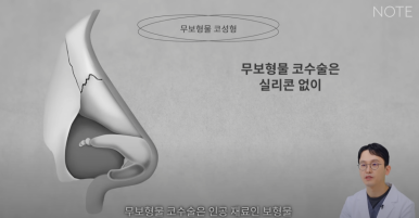 강남 코성형외과 코수술 잘하는 곳 추천 논현역 노트성형외과의 무보형물 자가연골 코성형수술로 자연스러운 코성형 관련 이미지 7