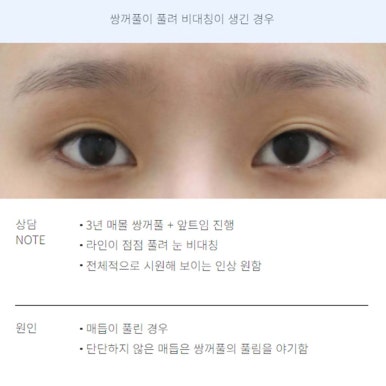 A Review of Revision Eyelid Surgery That Speaks for Itself: A Famous Eyelid Surgery Clinic Near Nonhyeon Station, Note Plastic Surgery’s Final Revision Eyelid Surgery Recommendations and Case Explanations image 4