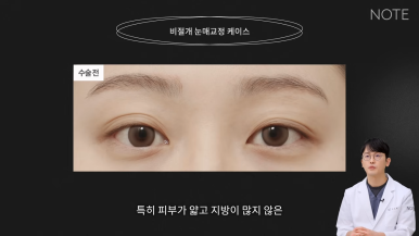 Recommended Famous Place for Double Eyelid Surgery and Eye Plastic Surgery in Nonhyeon: What Is Non-Incisional Ptosis Correction at Note Plastic Surgery in Gangnam? image 4
