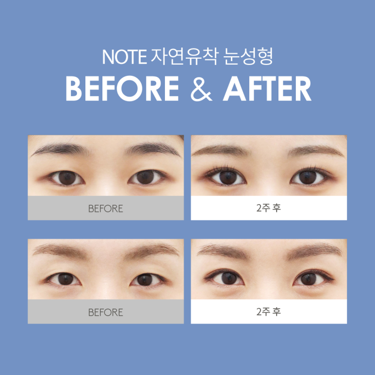 강남 눈성형 잘하는 병원, 자연유착 효과는? 노트성형외과의 오래가는 이중매몰 쌍꺼풀수술 관련 이미지 6