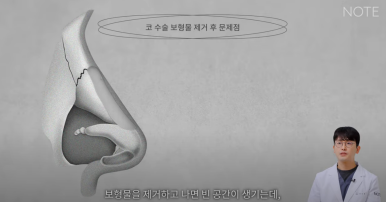 Recommended Gangnam Rhinoplasty Clinic: A Guide to Nose Surgery at Nonhyeon Note Plastic Surgery, Including Post-Rhinoplasty Inflammation and Implant Removal image 17