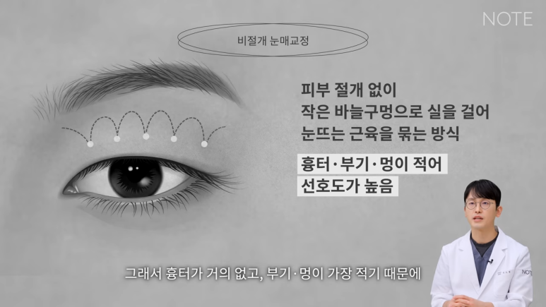 Recommended Famous Place for Double Eyelid Surgery and Eye Plastic Surgery in Nonhyeon: What Is Non-Incisional Ptosis Correction at Note Plastic Surgery in Gangnam? image 3