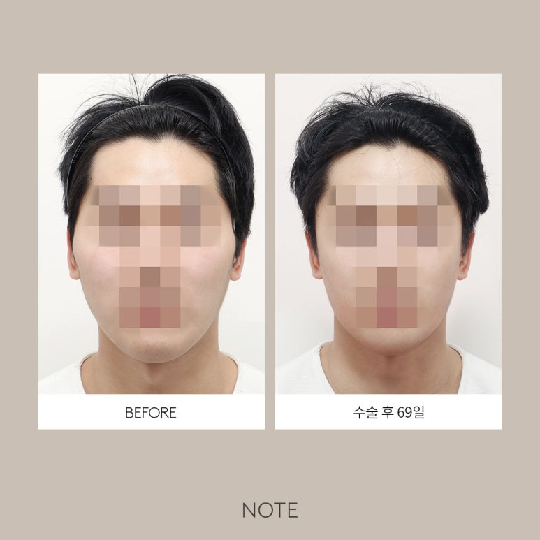 노트성형외과 _ 광대 축소의 모든것 관련 이미지 4