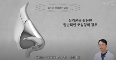 Recommended Gangnam Rhinoplasty Clinic: About Implant-Free Rhinoplasty and Standard Rhinoplasty, as explained by Note Plastic Surgery in Nonhyeon, where nose surgery is done well image 8