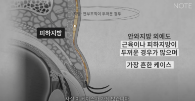 강남 눈성형외과 추천 눈수술 잘하는 곳 논현역 노트성형외과의 두꺼운 눈두덩이 눈위지방이 많다면? 관련 이미지 15