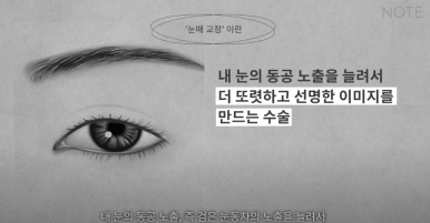 How to Fix Sleepy Eyes with Ptosis Correction and Eye Opening Surgery at Note Plastic Surgery near Nonhyeon Station, a Good Place for Double Eyelid Eye Surgery in Gangnam image 6