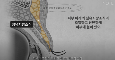 강남 눈성형외과 추천 눈수술 잘하는 곳 논현역 노트성형외과의 두꺼운 눈두덩이 눈위지방이 많다면? 관련 이미지 16