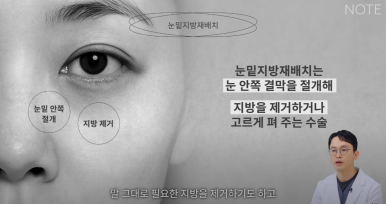 논현 눈성형외과 추천 하안검수술 눈밑지방재배치 잘하는 곳 강남 노트성형외과의 중년 눈성형 케이스 비교 분석 관련 이미지 8