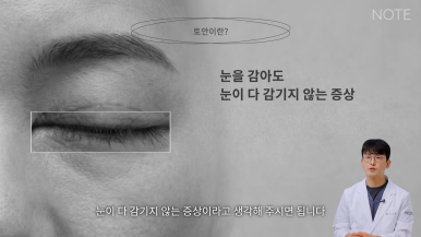 강남 눈재수술 성형외과 눈성형 잘하는 곳 논현 노트성형외과가 말하는 쌍꺼풀 부작용 토안이란? 관련 이미지 3
