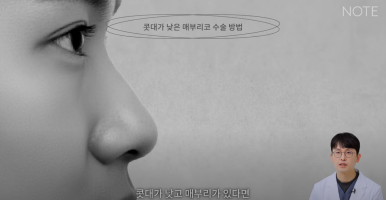 Gangnam Male Nose Surgery, Hump Nose Rhinoplasty, a Place Known for Good Natural Nose Surgery Recommendation: What Is the Hump Nose Surgery Method at Note Plastic Surgery in Nonhyeon? image 13