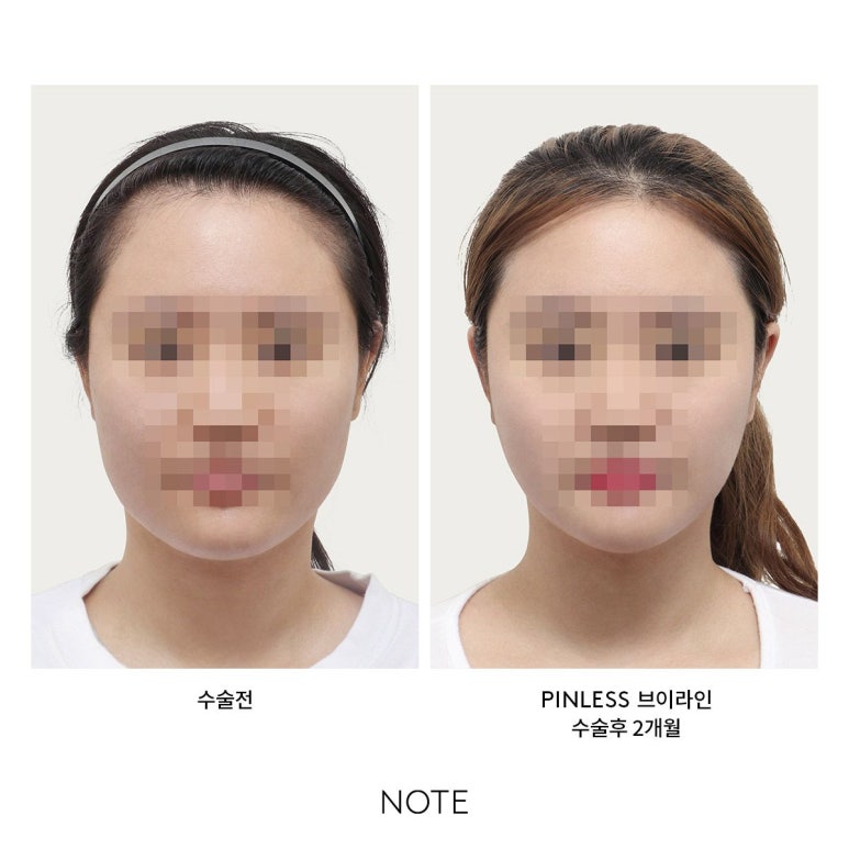 핀고정 없이 갸름하게 관련 이미지 2
