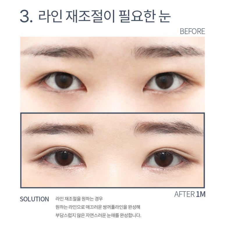 강남 쌍꺼풀재수술 잘하는 곳 논현역 노트성형외과의 소시지 쌍수 눈재수술 후기 관련 이미지 9