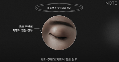 강남 눈성형외과 쌍꺼풀수술 잘하는 곳 논현역 노트성형외과의 불룩한 눈두덩이 원인과 적합한 케이스별 쌍수 방법은? 관련 이미지 10