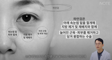 논현 눈성형외과 추천 하안검수술 눈밑지방재배치 잘하는 곳 강남 노트성형외과의 중년 눈성형 케이스 비교 분석 관련 이미지 13