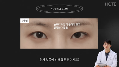 논현 트임성형 쌍꺼풀 눈수술 유명한 곳 추천 강남 노트성형외과의 트임을 하는 이유, 뒷트임, 밑트임이란? 관련 이미지 7