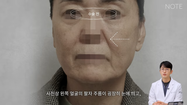 논현 안면거상 성형외과 리프팅 유명한 곳 강남 노트성형외과의 안면거상 케이스 리뷰 수술 전 고민 관련 이미지 7