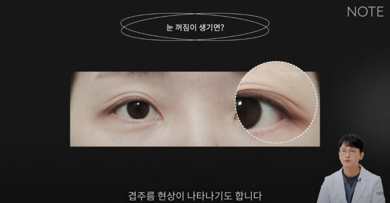 꺼진 눈이 생기는 이유는 따로 있다? 강남 눈성형 잘하는 곳 추천 노트성형외과의 눈꺼짐 해결을 위한 쌍커풀성형과 눈매교정, 지방이식수술 관련 이미지 10