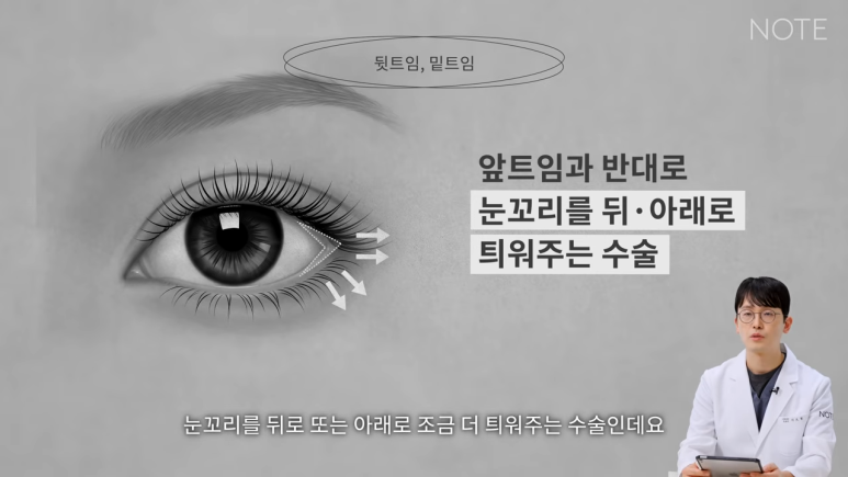논현 트임성형 쌍꺼풀 눈수술 유명한 곳 추천 강남 노트성형외과의 트임을 하는 이유, 뒷트임, 밑트임이란? 관련 이미지 3