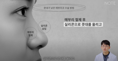 Gangnam Male Nose Surgery, Hump Nose Rhinoplasty, a Place Known for Good Natural Nose Surgery Recommendation: What Is the Hump Nose Surgery Method at Note Plastic Surgery in Nonhyeon? image 15