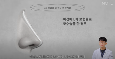 논현역 코수술 추천 코성형 잘하는 곳 강남 노트성형외과의 코수술 후 실리콘 보형물 교체를 해야하는 경우는? 관련 이미지 16