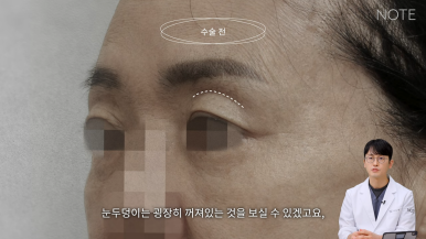 논현 안면거상 성형외과 리프팅 유명한 곳 강남 노트성형외과의 안면거상 케이스 리뷰 수술 전 고민 관련 이미지 6