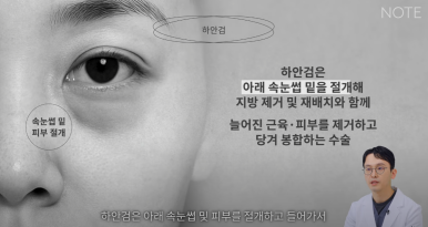 논현 눈성형외과 추천 하안검수술 눈밑지방재배치 잘하는 곳 강남 노트성형외과의 중년 눈성형 케이스 비교 분석 관련 이미지 10