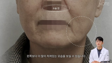 논현 안면거상 성형외과 리프팅 유명한 곳 강남 노트성형외과의 안면거상 케이스 리뷰 수술 전 고민 관련 이미지 8