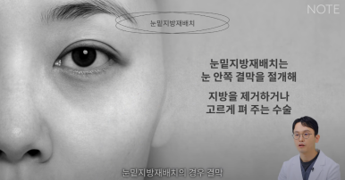 논현 눈성형외과 추천 하안검수술 눈밑지방재배치 잘하는 곳 강남 노트성형외과의 중년 눈성형 케이스 비교 분석 관련 이미지 6