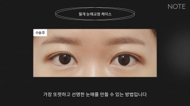 논현 쌍꺼풀수술 눈성형 유명한 곳 추천 강남 노트성형외과의 절개 눈매교정이란? 관련 이미지 7