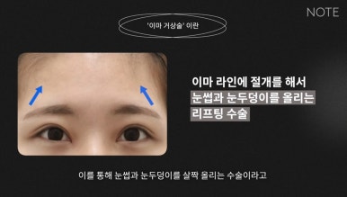 강남 성형외과 유명한 곳 논현역 리프팅 잘하는 곳 노트성형외과의 이마거상수술 쌍꺼풀수술 관련 이미지 7