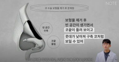 Recommended Gangnam Rhinoplasty Clinic: A Guide to Nose Surgery at Nonhyeon Note Plastic Surgery, Including Post-Rhinoplasty Inflammation and Implant Removal image 20