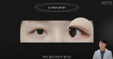 꺼진 눈이 생기는 이유는 따로 있다? 강남 눈성형 잘하는 곳 추천 노트성형외과의 눈꺼짐 해결을 위한 쌍커풀성형과 눈매교정, 지방이식수술 관련 이미지 9