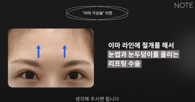 강남 성형외과 이마거상 잘하는 곳 논현역 노트성형외과의 이마거상 리프팅 전후 효과가 좋은 케이스는? 관련 이미지 8
