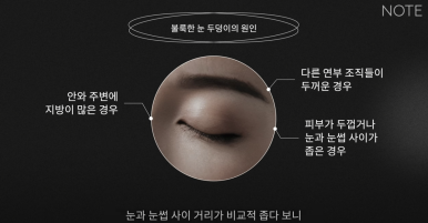 강남 눈성형외과 쌍꺼풀수술 잘하는 곳 논현역 노트성형외과의 불룩한 눈두덩이 원인과 적합한 케이스별 쌍수 방법은? 관련 이미지 14