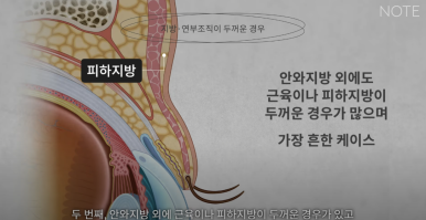 강남 눈성형외과 추천 눈수술 잘하는 곳 논현역 노트성형외과의 두꺼운 눈두덩이 눈위지방이 많다면? 관련 이미지 14